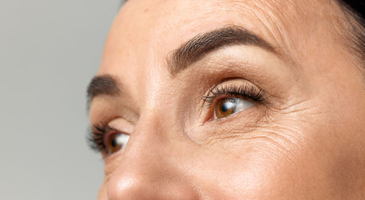 arrugas de expresion en marbella, tratamiento con neuromoduladores, tratamiento con botox, toxina botulinica en marbella