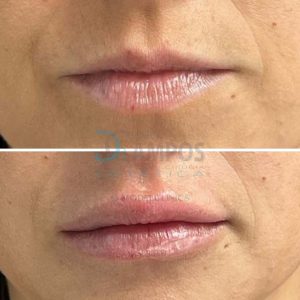 aumento de labios, antes después, marbella, clinica dr campos