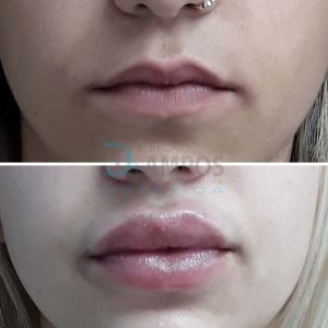 antes después aumento de labios en marbella, dr campos, marbella