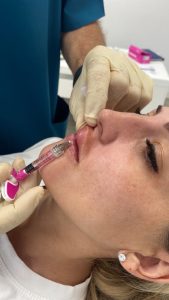 aumento de labios con ácido hialurónico dr campos en marbella y el campo de gibraltar