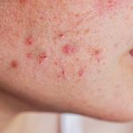 dermatólogo marbella, acné, rosácea, urticaria, dermatitis