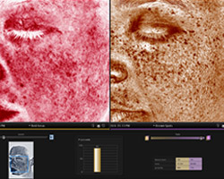 dermatología en marbella, diagnóstico facial con cámara de precisión, diagnóstico facial con Visia