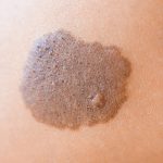 dermatología patológica en marbella, diagnóstico y tratamiento de cáncer de piel