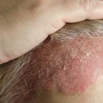 dermatología clínica en marbella, tratamiento de psoriasis, dermatitis