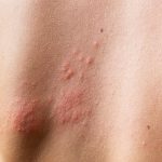 dermatología clínica en marbella, tratamientos de la pial