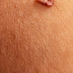 dermatología clínica en marbella, eliminar verrugas, eliminar lunares