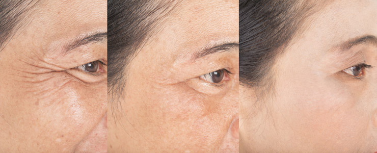 resultado de los neuromoduladores en marbella, efecto de botox en marbella,