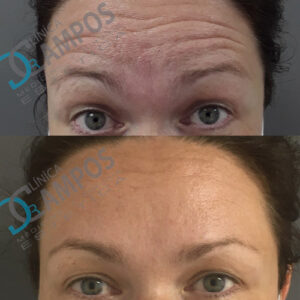 resultado antes después de eliminar arrugas en la frente con botox en marbella