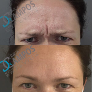 resultado antes después de eliminar las arrugas de entrecejo con botox en marbella
