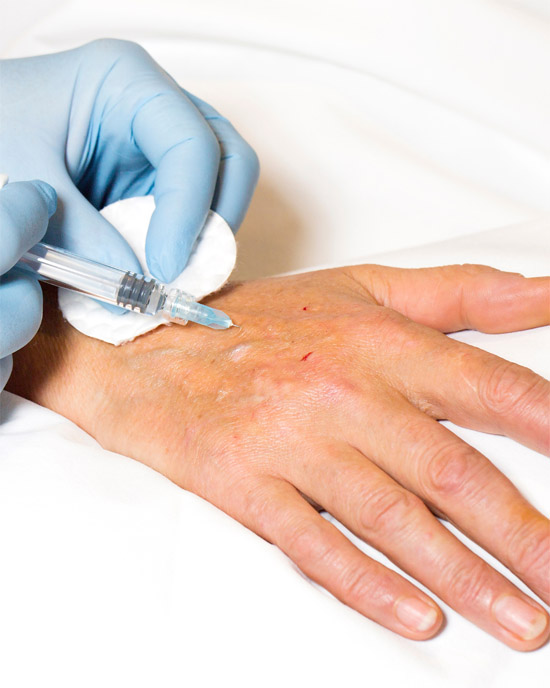 polinucleótidos en marbella para rejuvenecer las manos, adn de salmón, esperma de salmón, rejuvenecimiento de manos, medicina estética marbella, clínica estética marbella, médico estético marbella