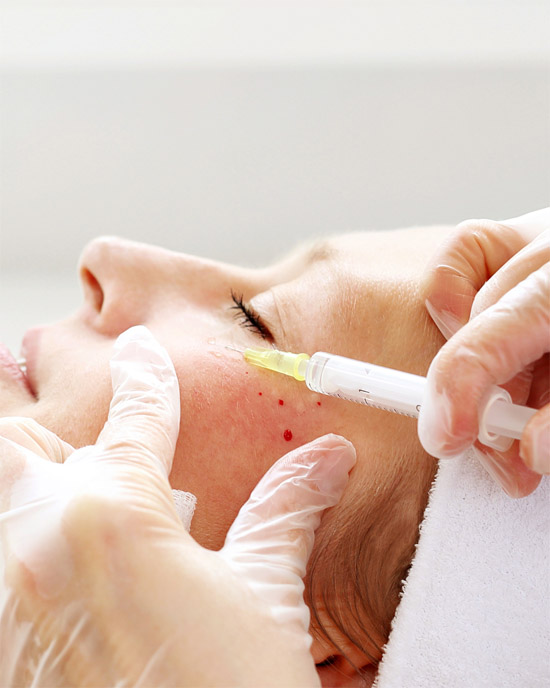 polinucleótidos en marbella, adn de salmón, tratamiento de ojeras en marbella, tratamiento sin overfiller, medicina estética marbella, clínica estética marbella , médico estético marbella