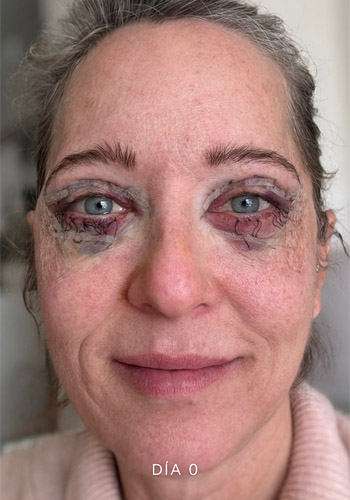 Recuperación después de una blefaroplastia en Marbella inmediato después