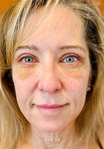 Recuperación después de blefaroplastia completa en Marbella, DÍA CATORCE después de la cirugía, Clínica estética en Marbella