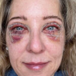 Recuperación después de una blefaroplastia completa en Marbella, SEGUNDO día después de la cirugía, Dr Campos