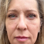 Recuperación después de blefaroplastia completa en Marbella, DÍA veinte y uno después de la cirugía, Clínica estética en Marbella