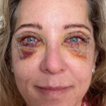 Recuperación después de blefaroplastia completa en Marbella, tercer día después de la cirugía, Clínica Dr Campos