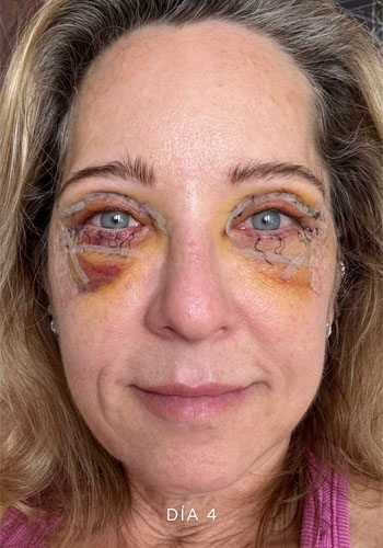 Recuperación después de blefaroplastia completa en Marbella, CUARTO DÍA después de la cirugía, Clínica Dr Campos