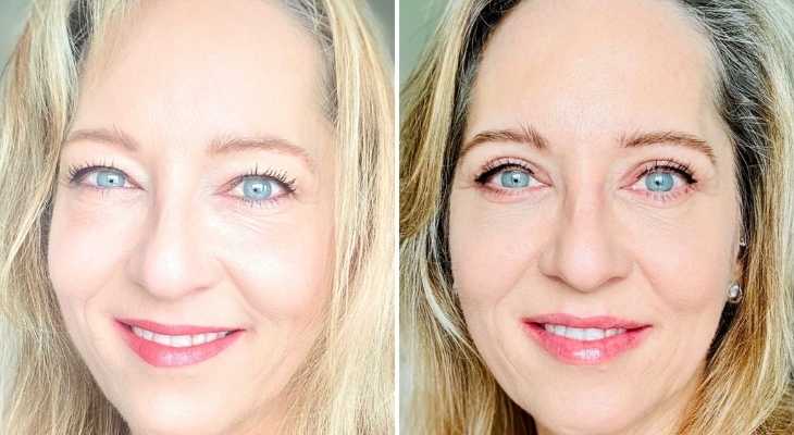 recuperación después de blefaroplastia completa en Marbella, resultado antes-después de la cirugía.