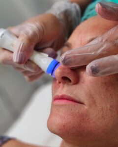 mejor limpieza facial en marbella, clinica estetica marbella, aquapure marbella