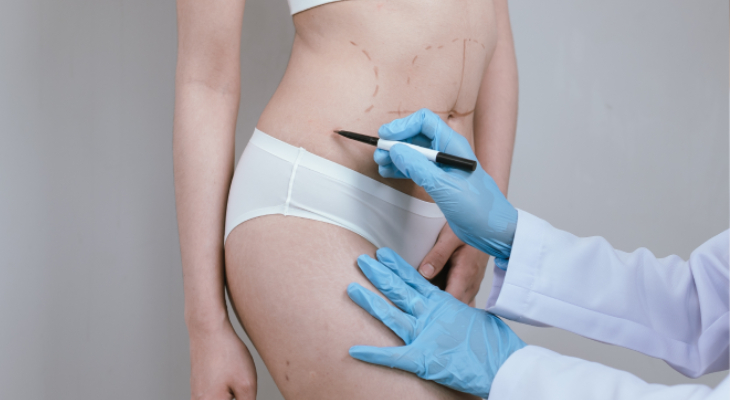 Diferencias entre Liposucción y Lipoescultura