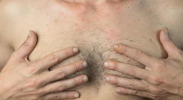 Cómo eliminar la ginecomastia en hombres