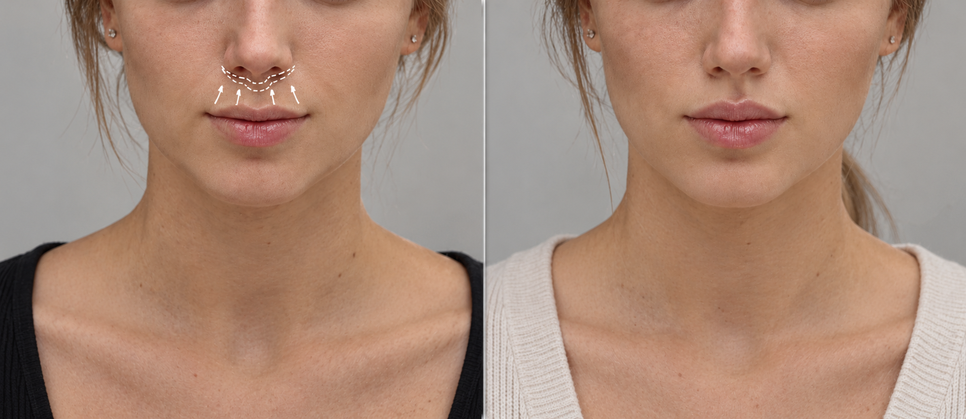 Resuelve las dudas sobre la cirugía Liplift